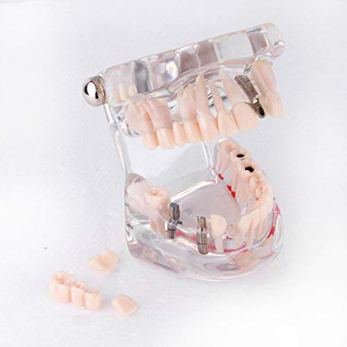 Modelo dental, Akozon Modelo de denticiÃ³n dental 3D Modelo de implantaciÃ³n dental para enseÃ±anza de dientes extraÃ­blesï¼ˆTransparenteï¼‰