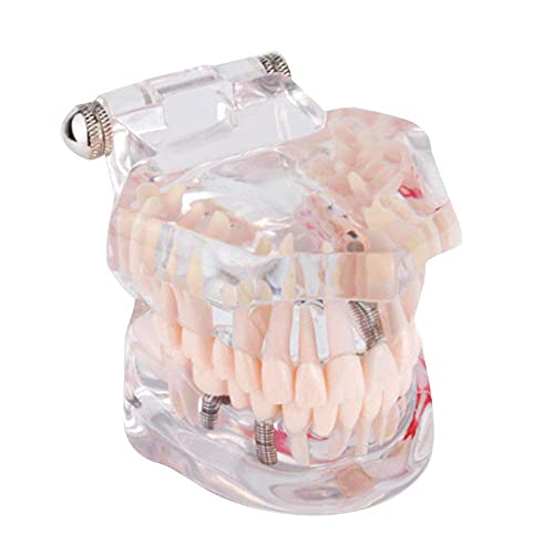 Modelo dental, Akozon Modelo de dentición dental 3D Modelo de implantación dental para enseñanza de dientes extraíbles（Transparente）