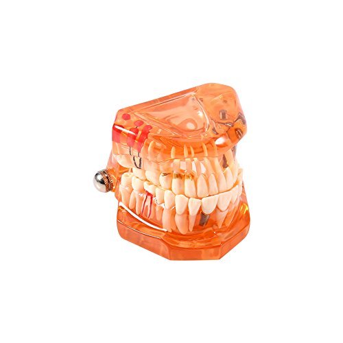 Modelo de dientes - Dientes dentales extraíbles Modelo de implante Herramienta de demostración de dentista para la enseñanza del estudio de la escuela dental, Naranja